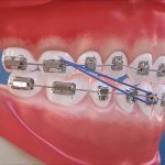 elastics azules